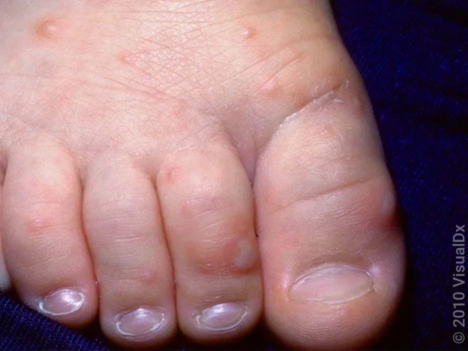 Close-up of an infant’s foot with small, red bumps and white blisters in hand, foot, and mouth disease.