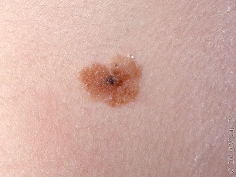 Close-up of an atypical mole. 