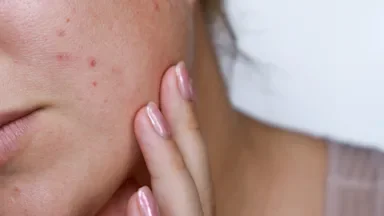 Close-up of a face with acne.
Tatjana Meininger/iStock via Getty Images Plus  