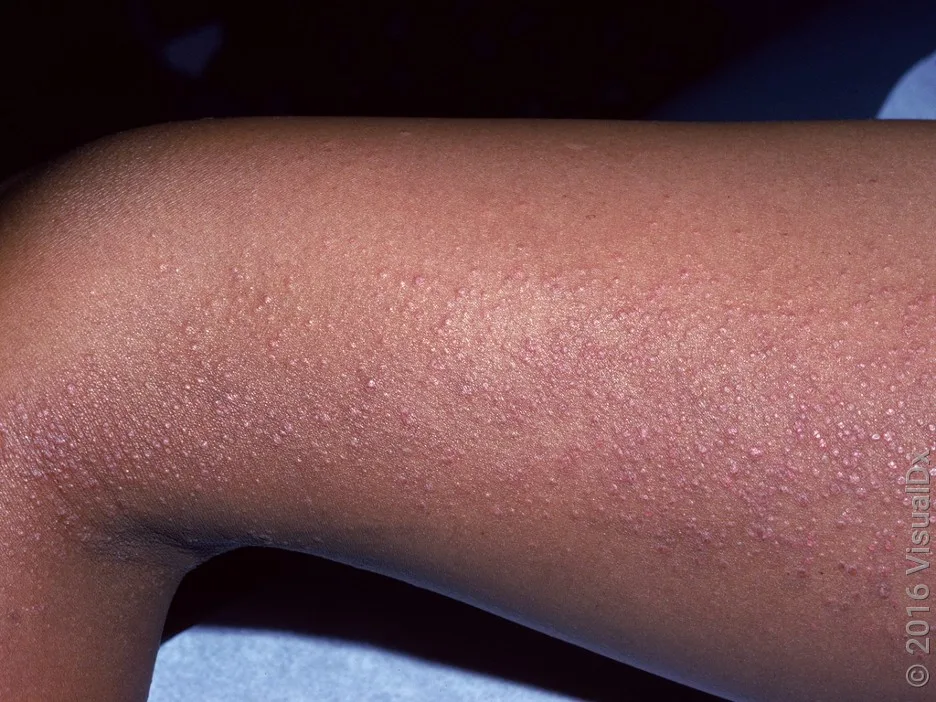 Close-up of eczema (atopic dermatitis) on the leg. 