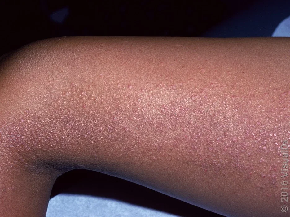 Close-up of eczema (atopic dermatitis) on the leg. 