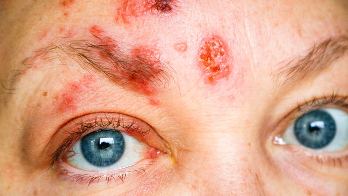 Extreme close-up of a person's eyes with a severe rash on their forehead and eyelids. They have bright blue eyes.