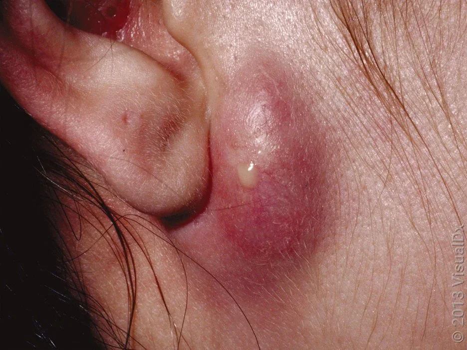 Close-up of an infected sebaceous cyst on the face.