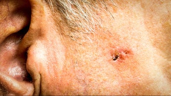 closeup melanoma-833175682