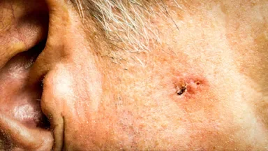 Extreme close-up on older man's melanoma on his face.
flik47/iStock via Getty Images
