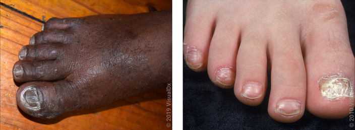 Thickened Toe Nails - Home Visit Foot Care