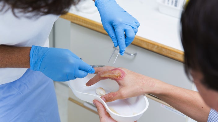 A nurse treats a patient with a burn on his finger.