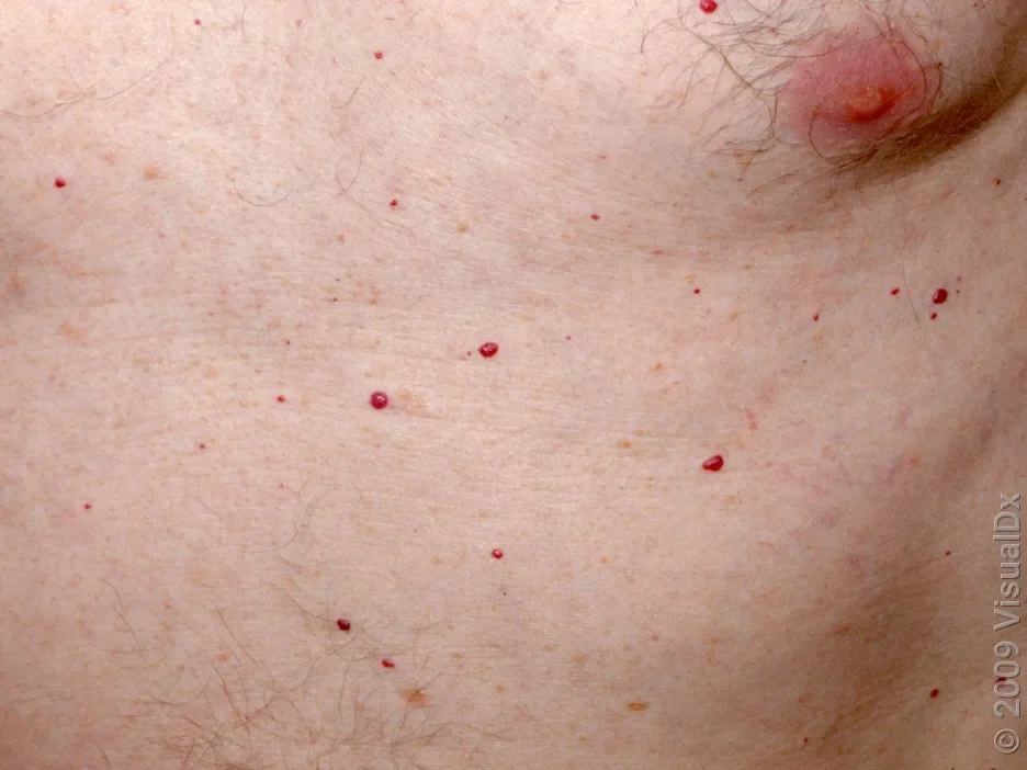 Close-up of several senile angiomas on the chest and abdomen. 