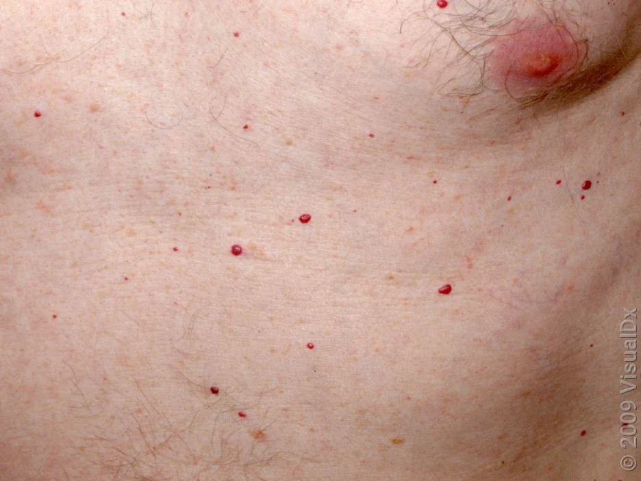 Close-up of several senile angiomas on the chest and abdomen. 