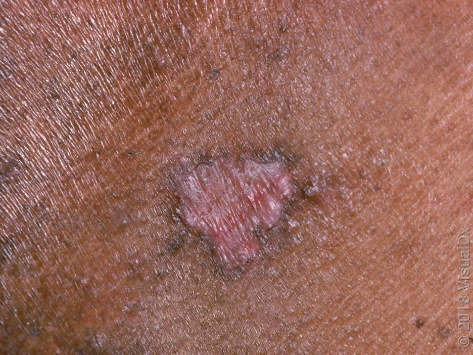 An early-stage skin cancer called squamous cell carcinoma in situ on darker skin.