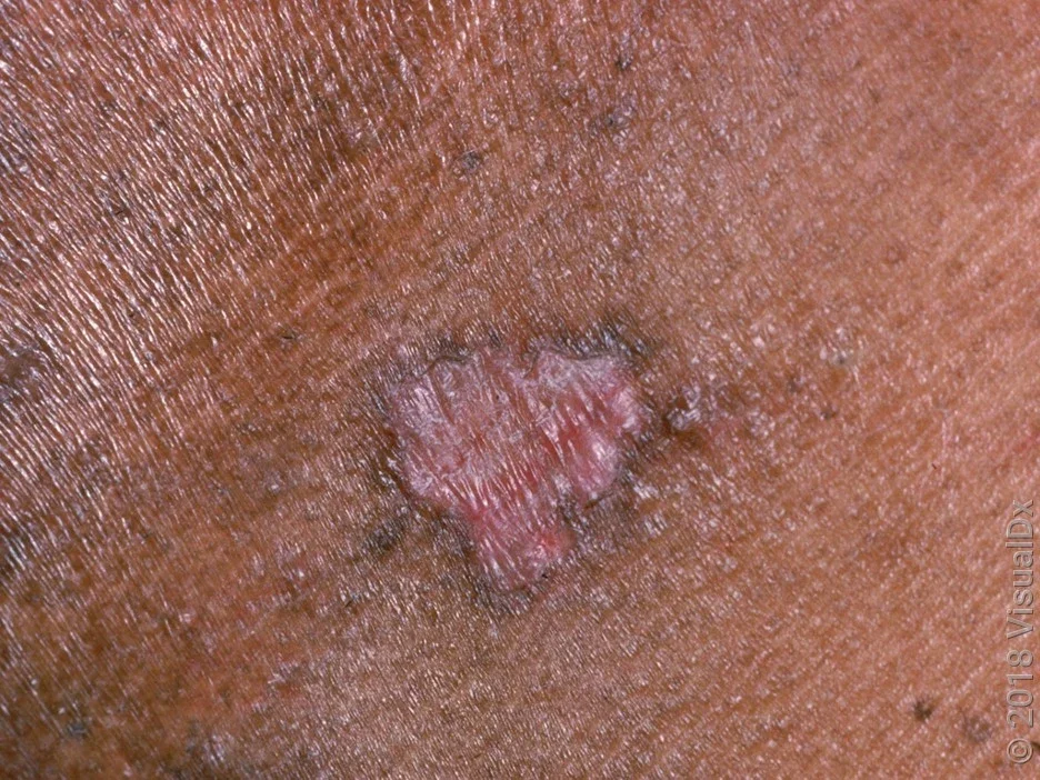 An early-stage skin cancer called squamous cell carcinoma in situ on darker skin. 