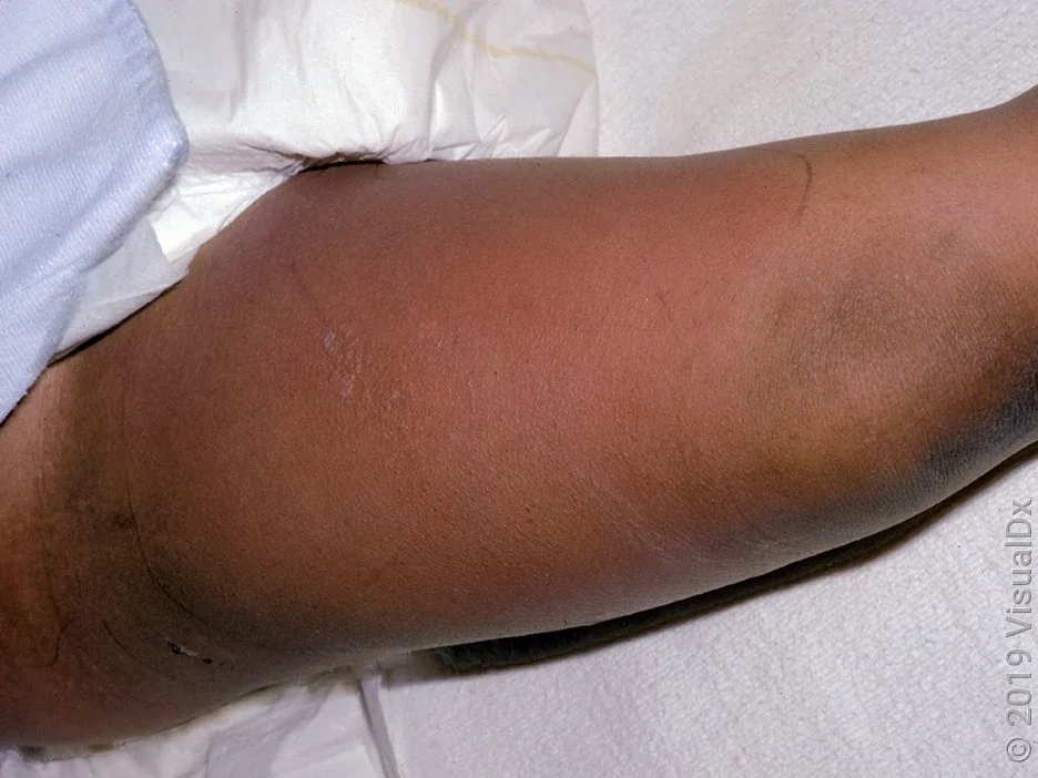 Signs of cellulitis include spreading redness. 