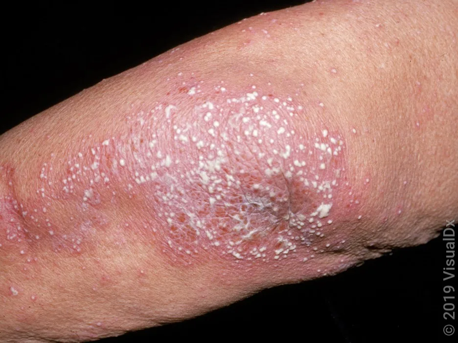 Close-up of an elbow with many white pus-bumps on a light pink patch.