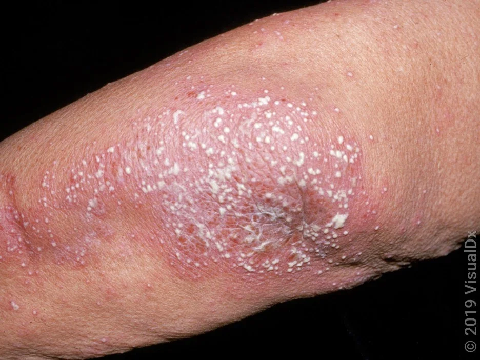 Close-up of an elbow with many white pus-bumps on a light pink patch.