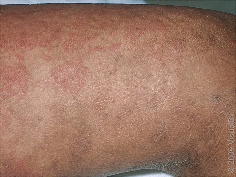 A hive-like drug rash on the leg. 