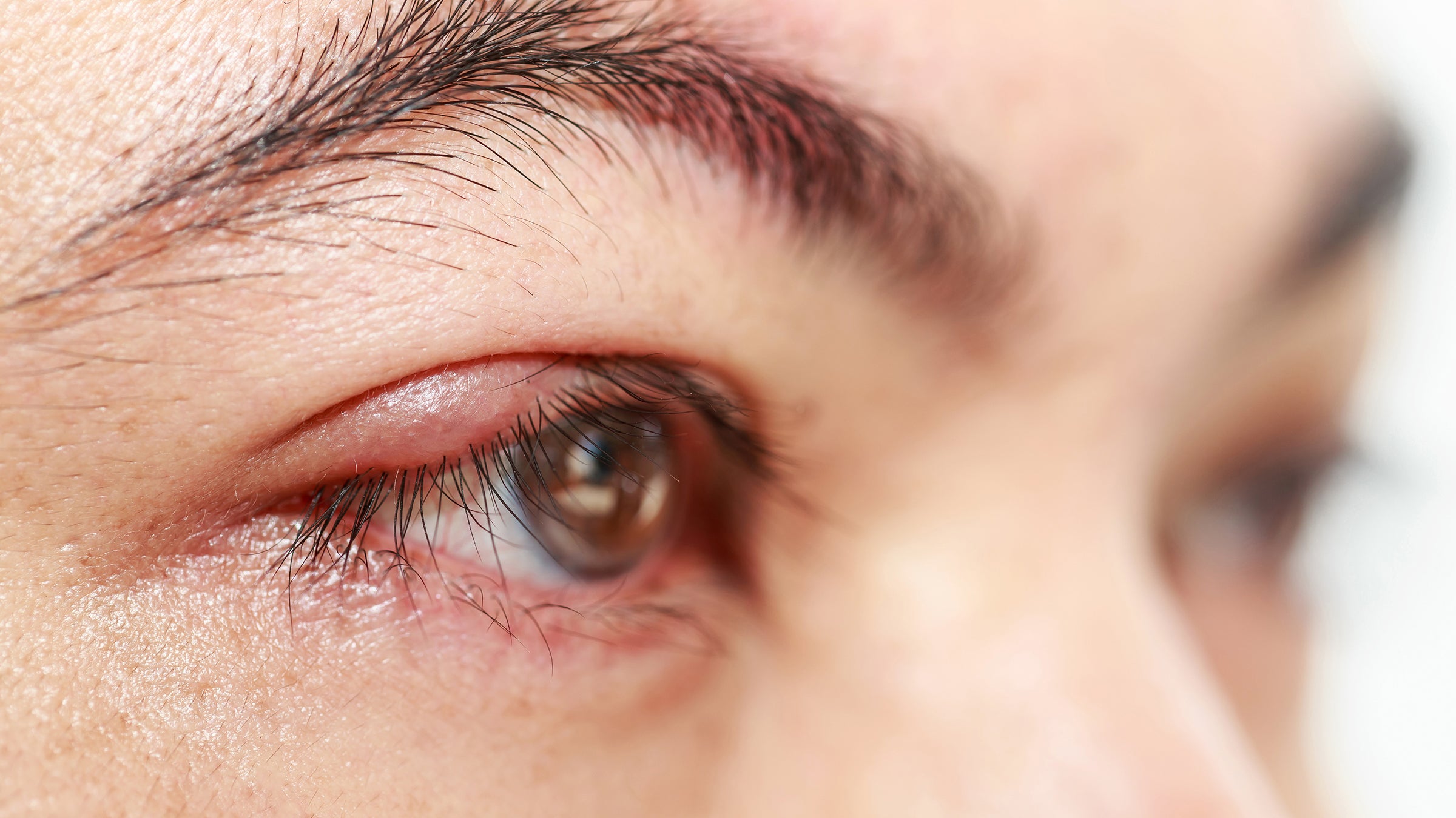 Health: Eye pain: syte on eye-476009012