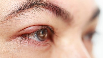 Health: Eye pain: syte on eye-476009012