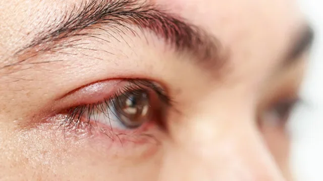 Health: Eye pain: syte on eye-476009012