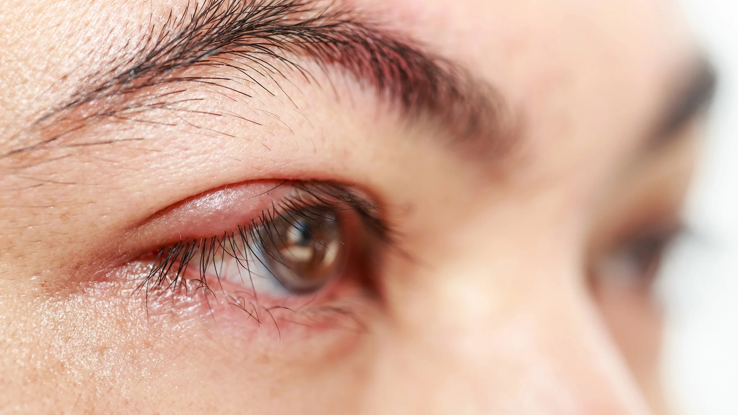 Close-up of an eye with a stye.