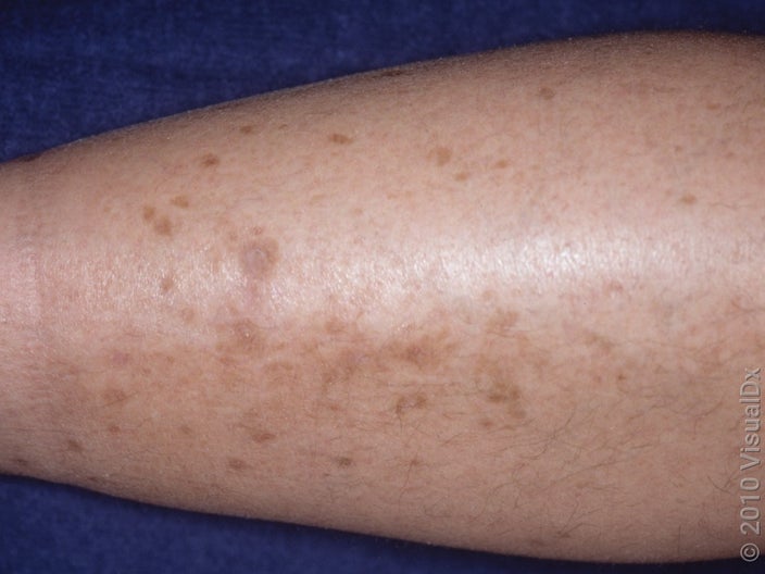 Close-up of diabetic dermopathy on the shin. 