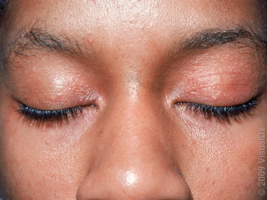 Close-up of allergic skin rash on the eyelids. 