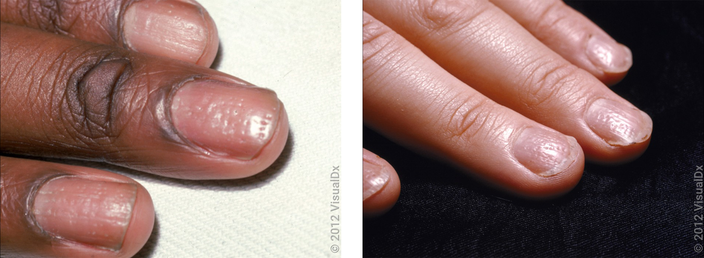 Left: Close-up of nails with many pits. Right: Close-up of nails with many pits.