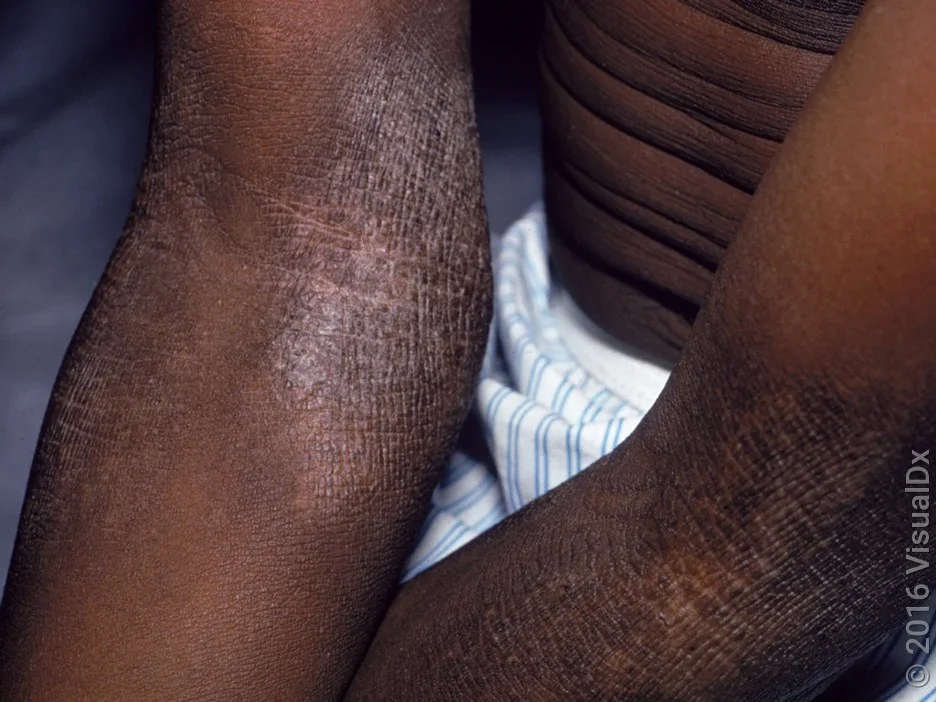 Eczema on Black Skin: Symptoms and Images - GoodRx