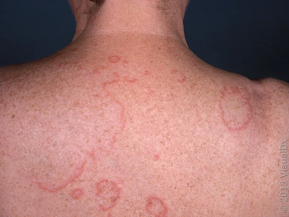 Granuloma annulare on the back.