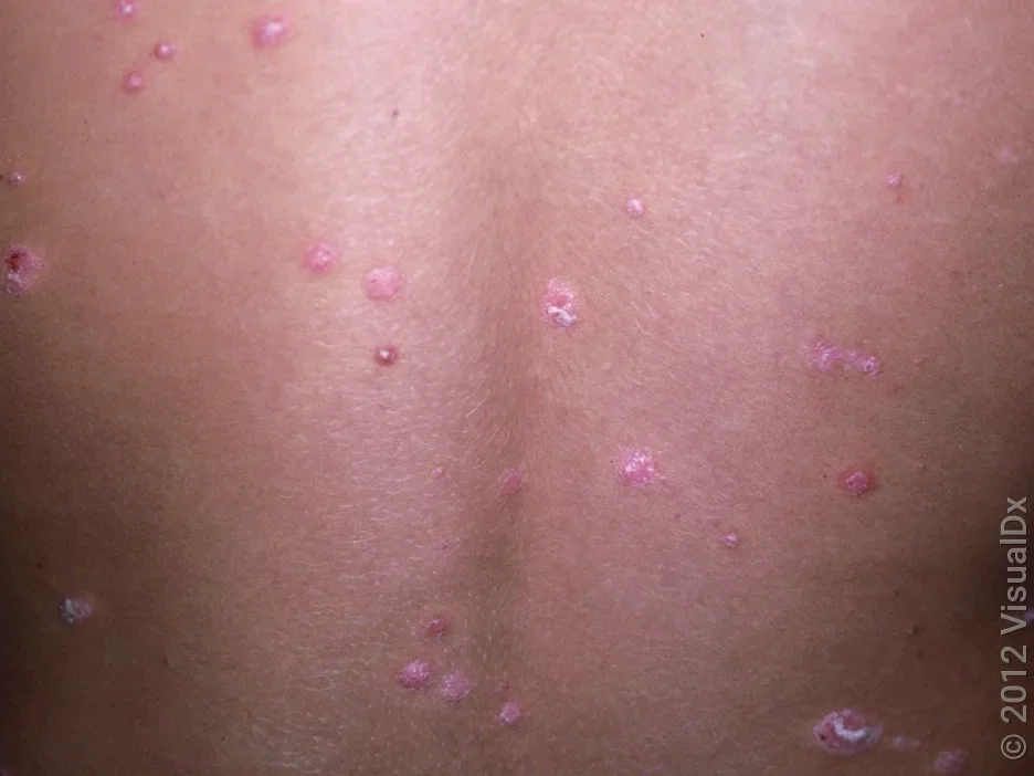 Close-up of back with small, violet-pink, scaly patches in guttate psoriasis.