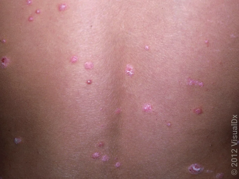 Close-up of back with small, violet-pink, scaly patches in guttate psoriasis. 