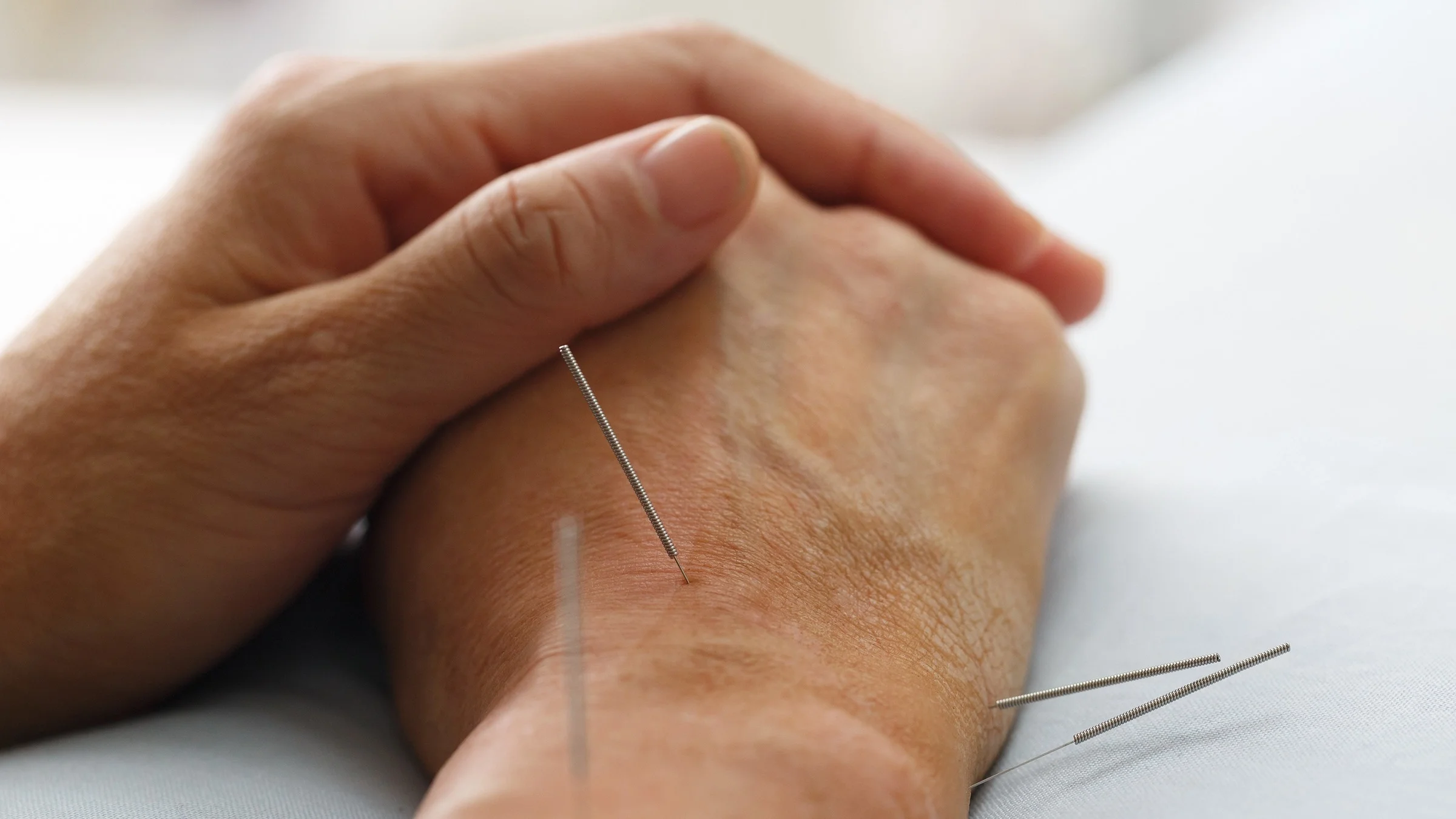 Close-up of a person's hands resting on top of each other while they have acupuncture needles in different pressure points.