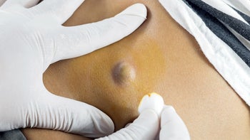 Dermatology: closeup sebaceous cyst 544001676