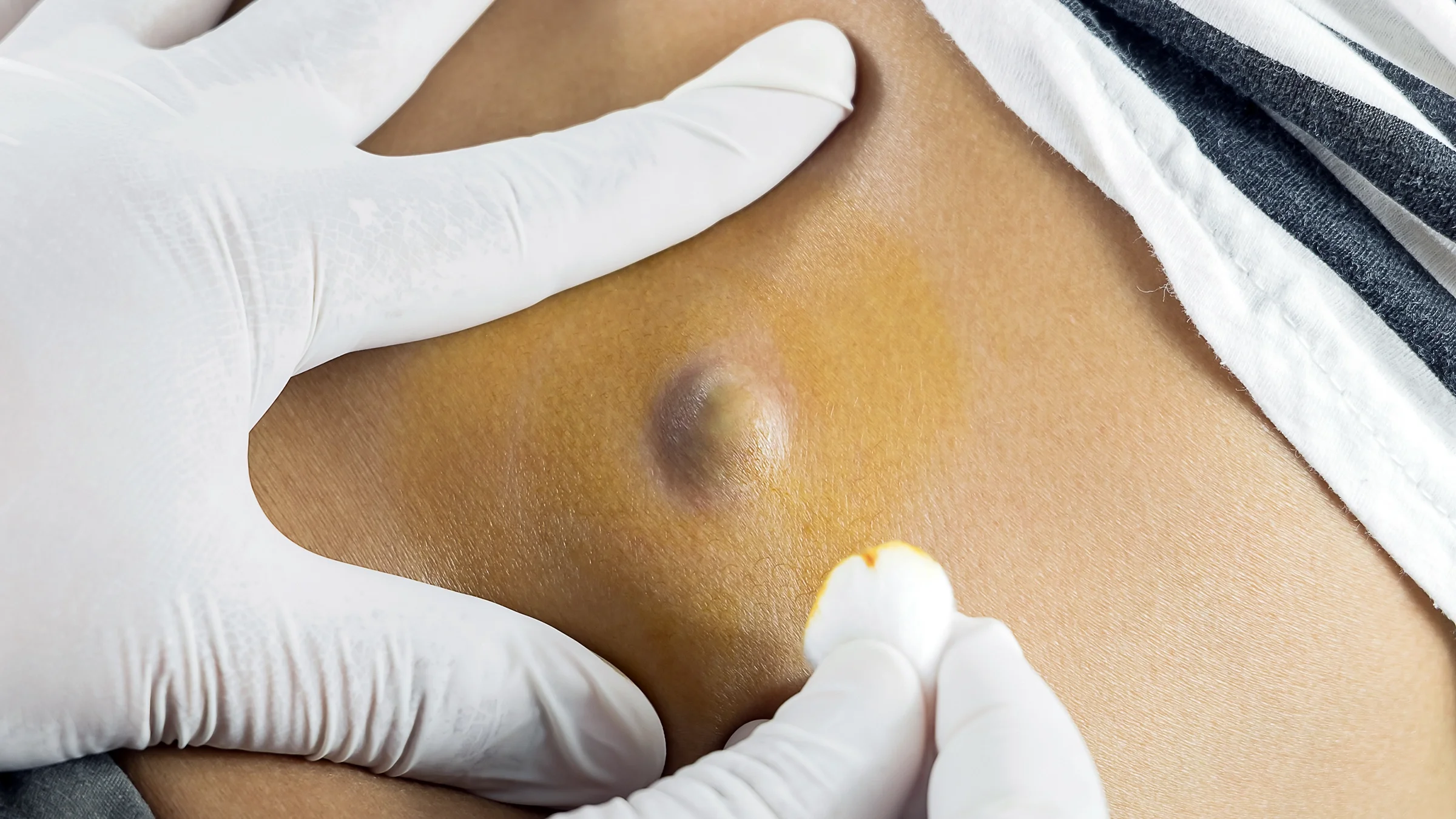 A close-up image shows a sebaceous cyst on a woman's back.