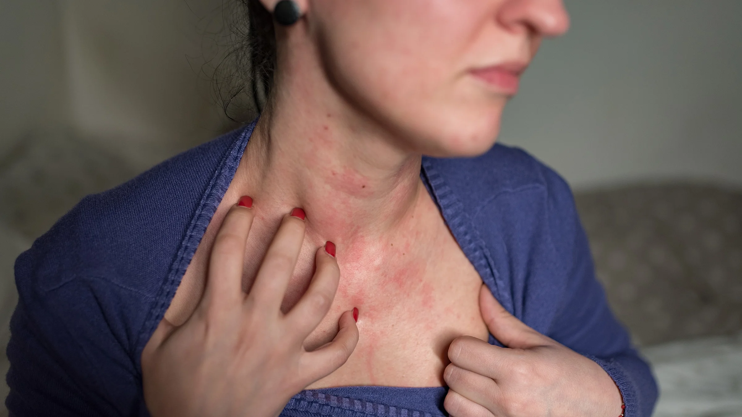 Woman in a purple blouse with a skin allergy on her chest and neck.