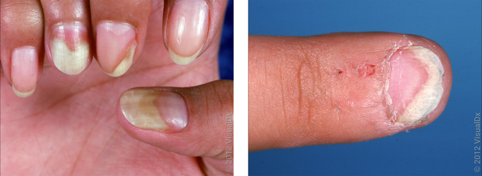 Left: Close-up of fingernails with white patches at the tips. Right: Close-up of finger nail with white patch at tip. 