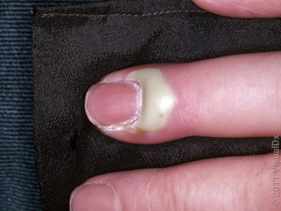 Close-up of a nail with a large collection of white pus around the nail.