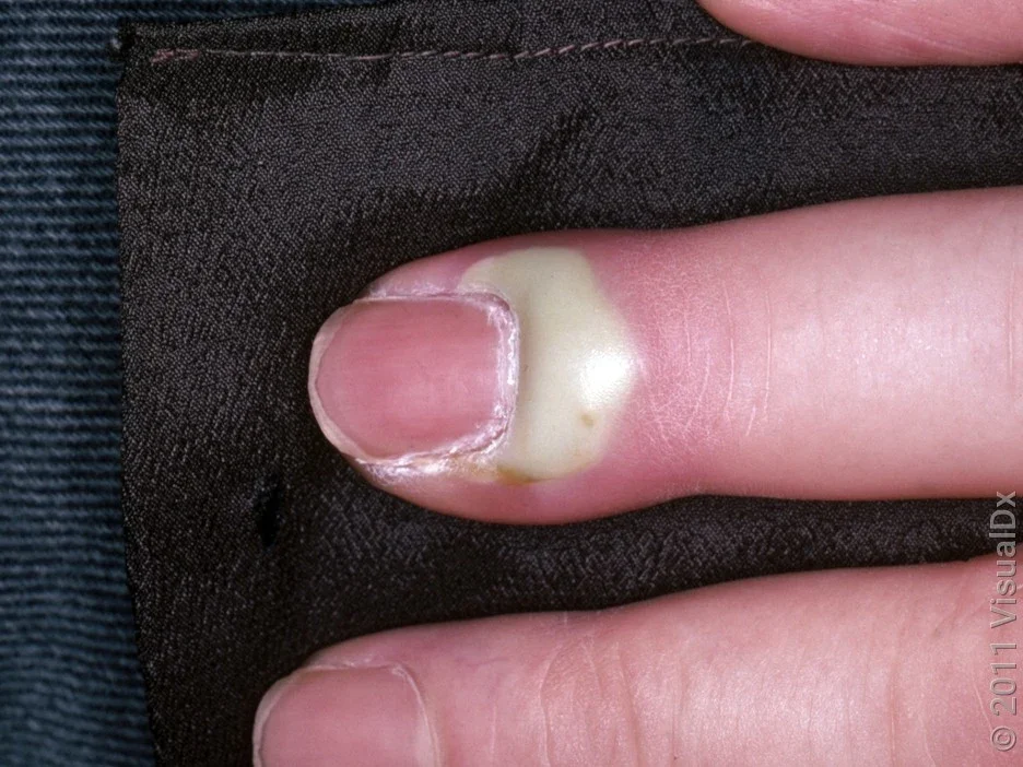Close-up of a nail with a large collection of white pus around the nail. 