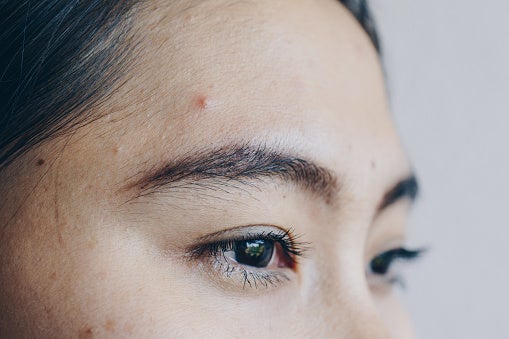 i have a pimple in the middle of my forehead i have a pimple in the middle of my forehead