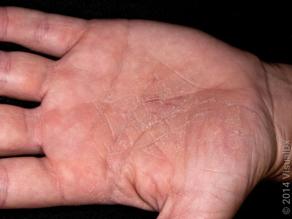 Close-up of a palm with mild eczema. 