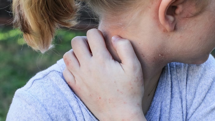 Little blonde girl scratching her neck and showing the scabies marks on her hands.