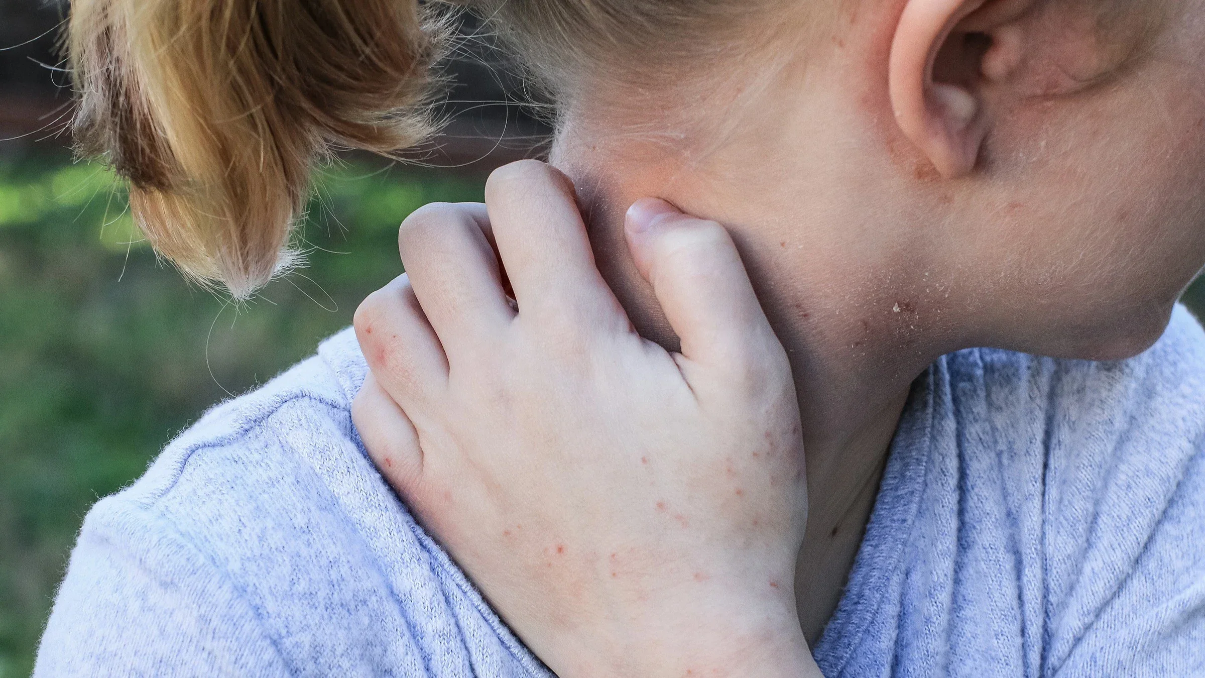 Little blonde girl scratching her neck and showing the scabies marks on her hands.
Lisa Kingdon/iStock via Getty Images