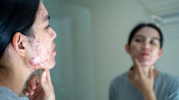 acne: woman looking at acne in the mirror 1820363851