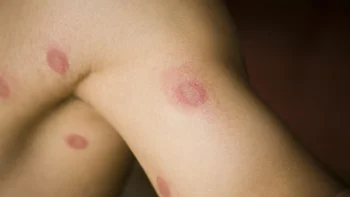 Health: Eczema: ringworm arm armpit-176099272
