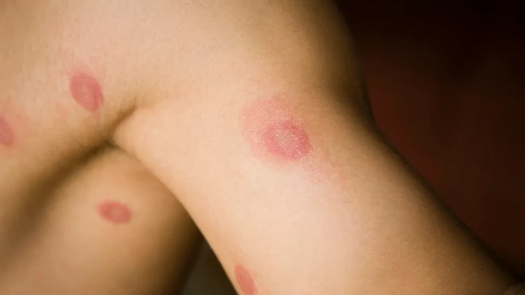 Health: Eczema: ringworm arm armpit-176099272