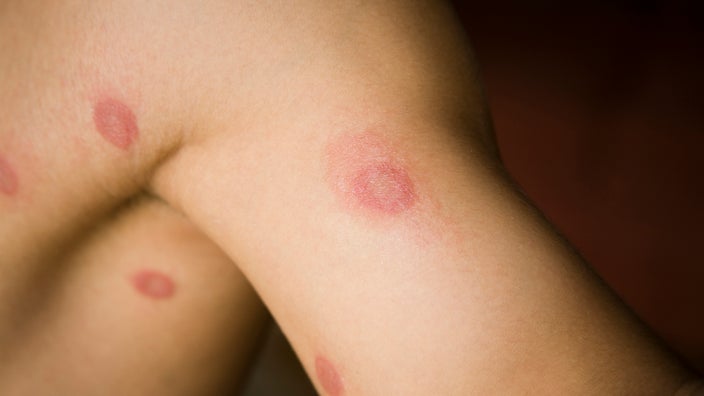 This will help fungal rashes, but not all rashes under the breast