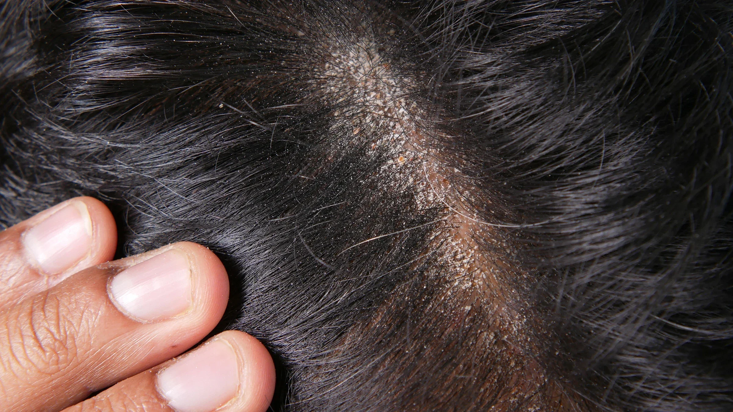 Close-up of a man’s scalp with dandruff
towfiqu ahamed/iStock via Getty Images Plus