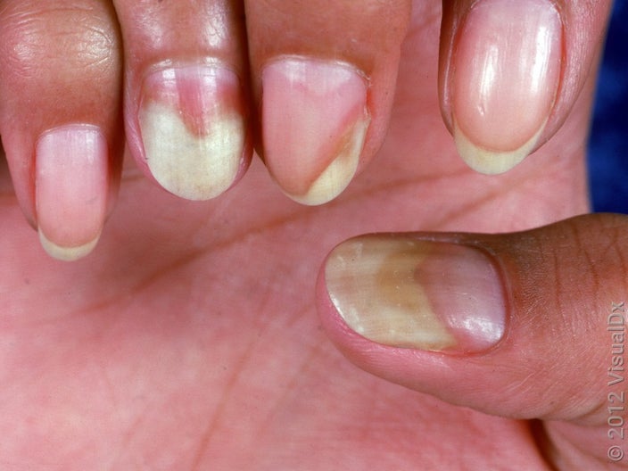 Close-up of fingernails with white and yellow-pink discoloration (nail psoriasis). 