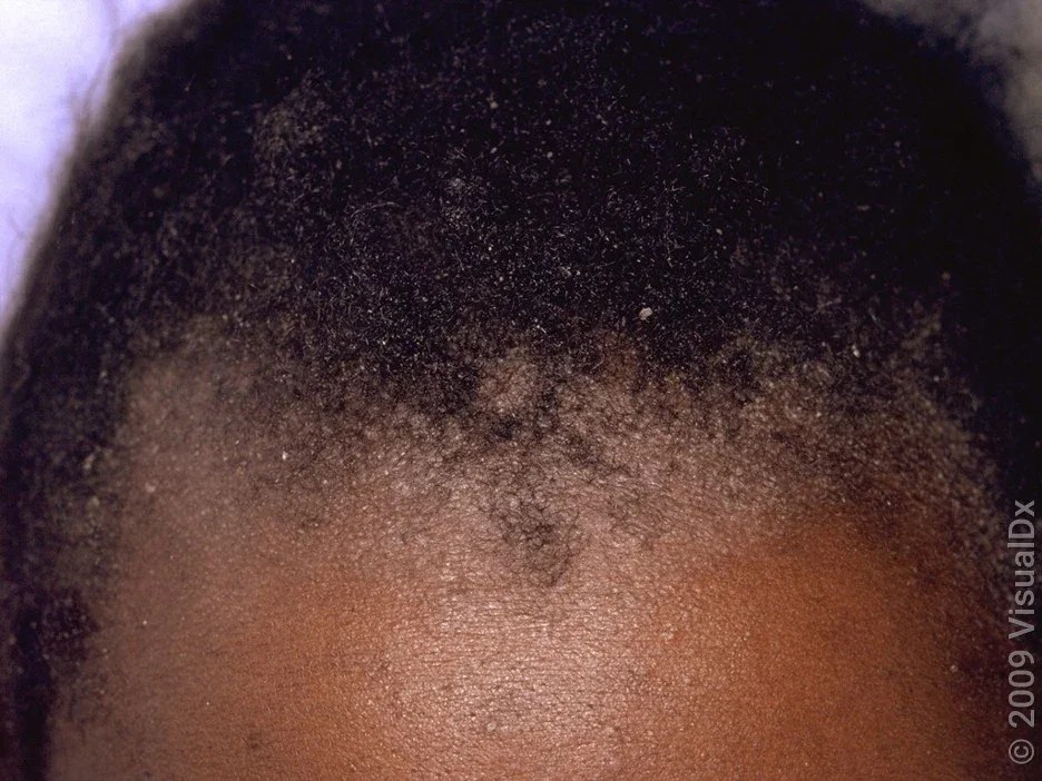 Close-up of scalp psoriasis around the hairline.