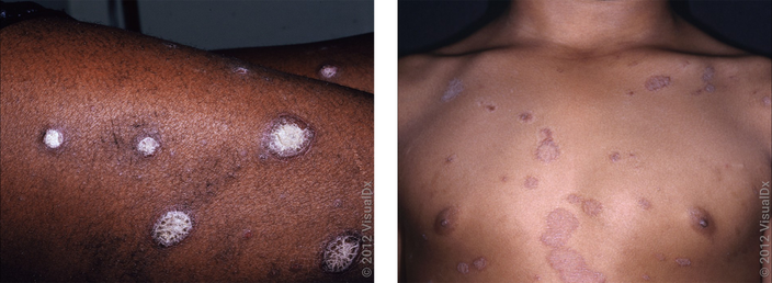 Left: Close-up of skin with thick patches with white scale in psoriasis. Right: Violet-brown round patches with fine scale on the chest in psoriasis.