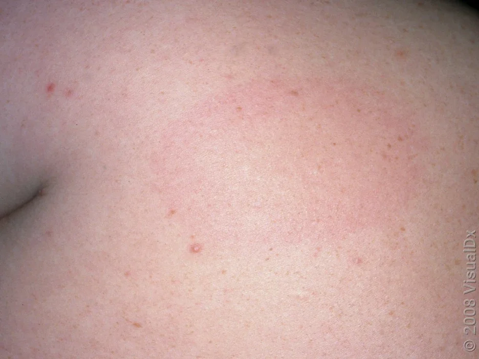 Close-up of the back with a faint pink, round patch on the skin from Lyme disease. 